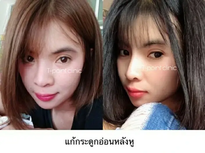 รีวิวเสริมจมูก เชียงใหม่