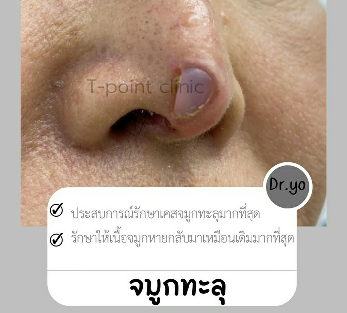 ทำจมูก เชียงใหม่