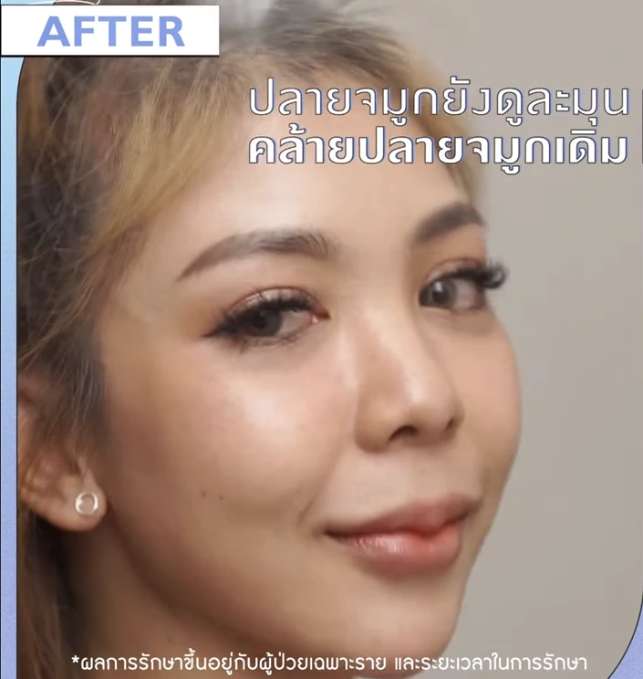 แก้จมูกทะลุเชียงใหม่