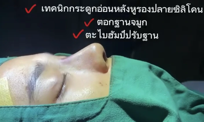 คลินิกทำจมูก เชียงใหม่